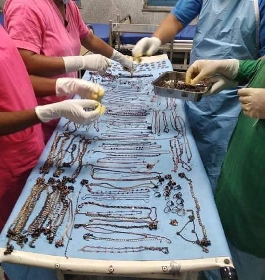 1.5 Kg Jewellery, Coins Removed From Woman’s Stomach In Bengal