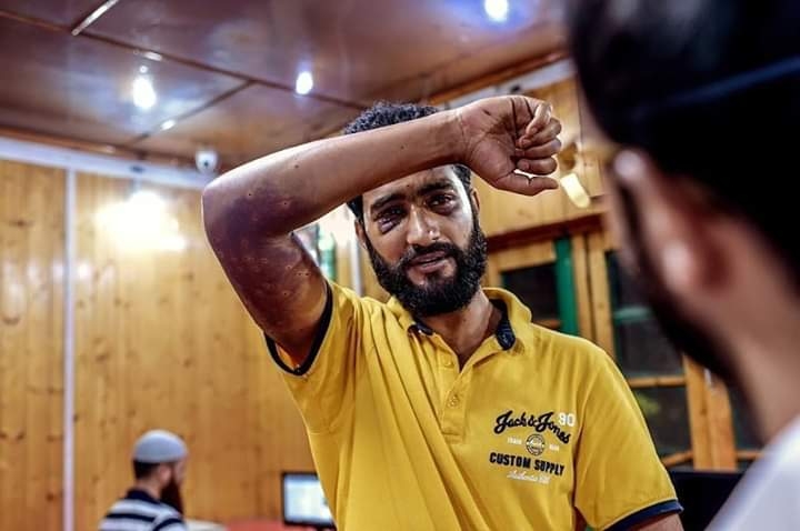 Sameer Ahamed, a page designer for local newspapers, whose eyes and arms were injured from pellets, in Srinagar.